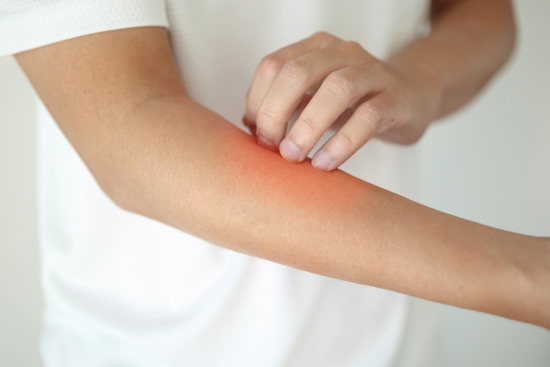 scratching forearm