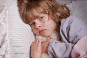 Best Allergy Antihistamine for Hives (Urticaria)