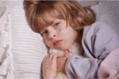 Best Allergy Antihistamine for Hives (Urticaria)