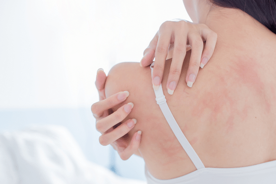 antihistamines for eczema image of itchy skin